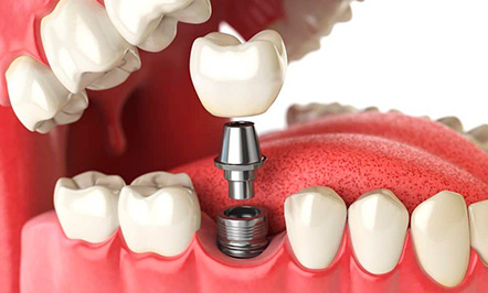 implantes implantes